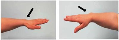 Report of a Novel SHOX Missense Variant in a Boy With Short Stature and His Mother With Leri–Weill Dyschondrosteosis